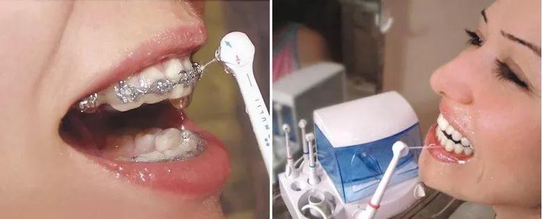 ирригатор как пользоваться правильно для зубов видео
